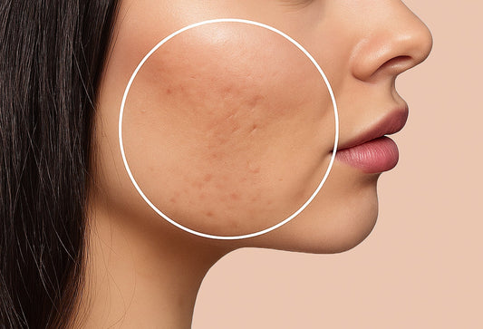 How to Minimise Pores on Face Naturally: Tips for Smooth, Healthy Skin